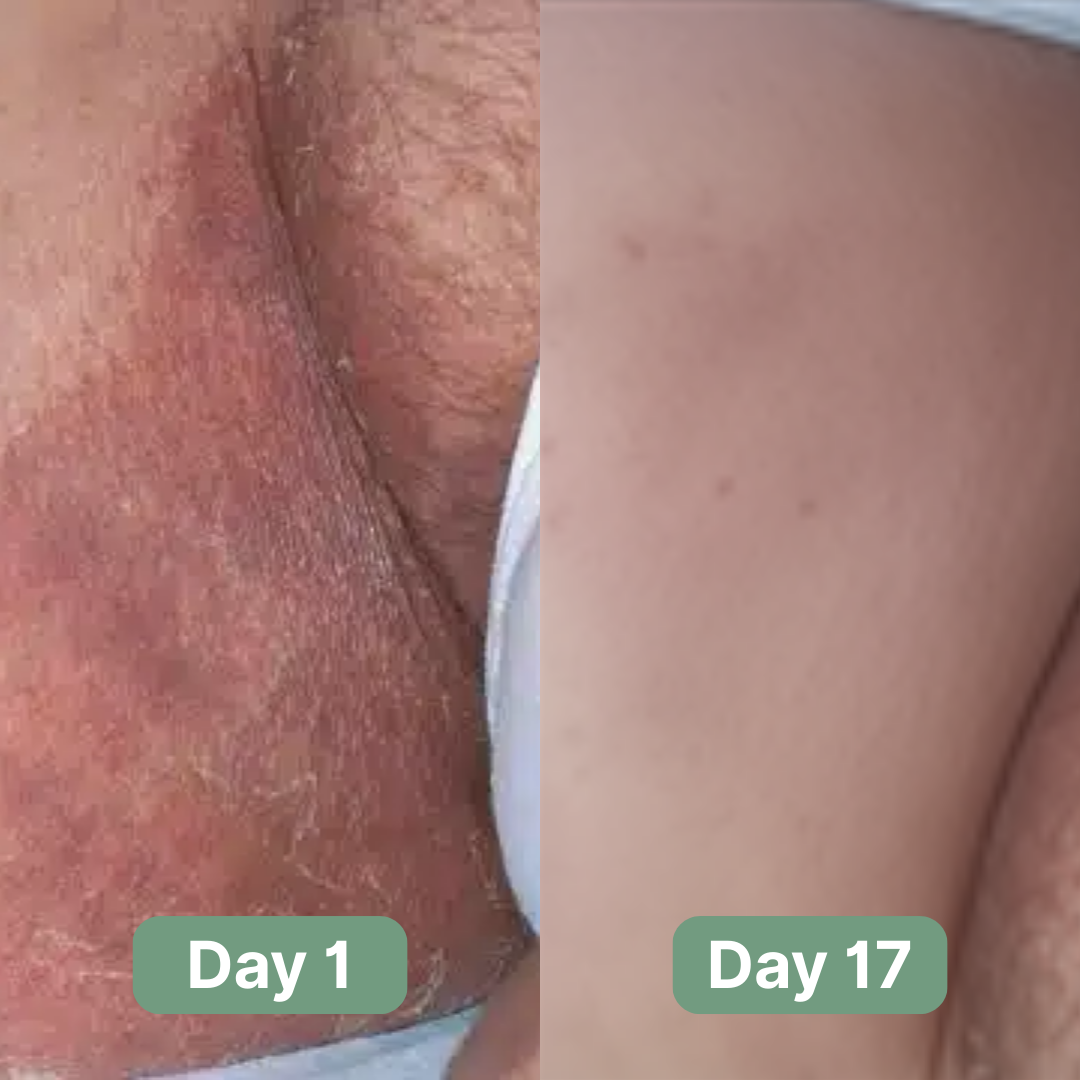 LOVILDS Antifungal Soap