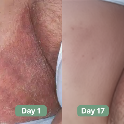 LOVILDS Antifungal Soap