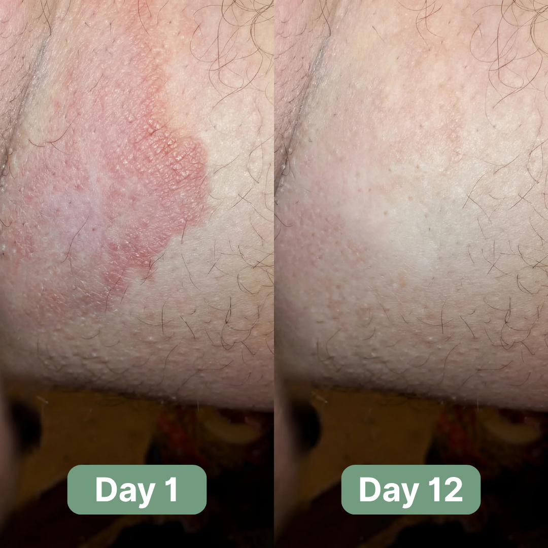 LOVILDS Antifungal Soap