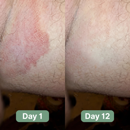 LOVILDS Antifungal Soap